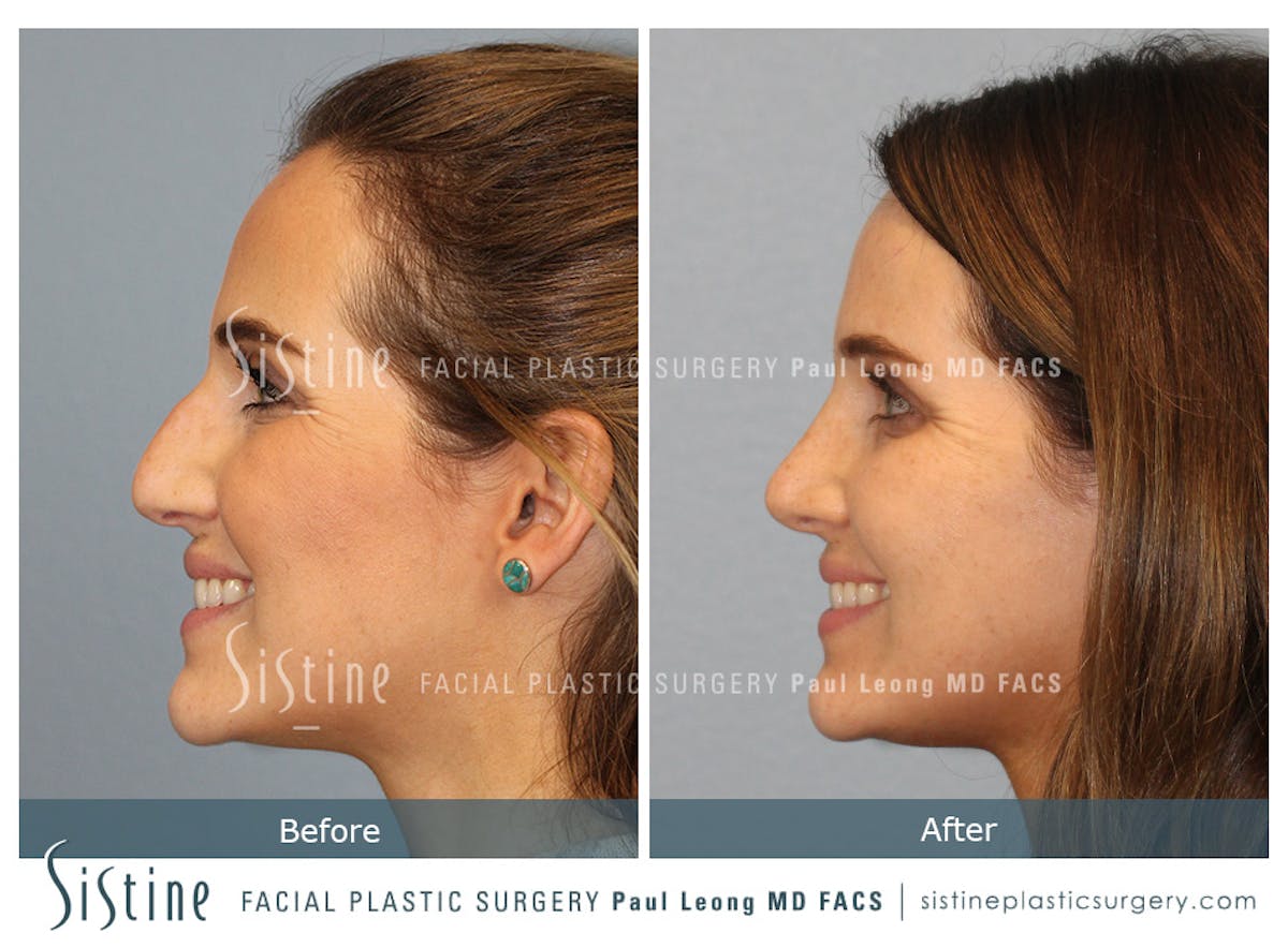 Rhinoplasty Before & After Gallery - Patient 985131 - Image 4