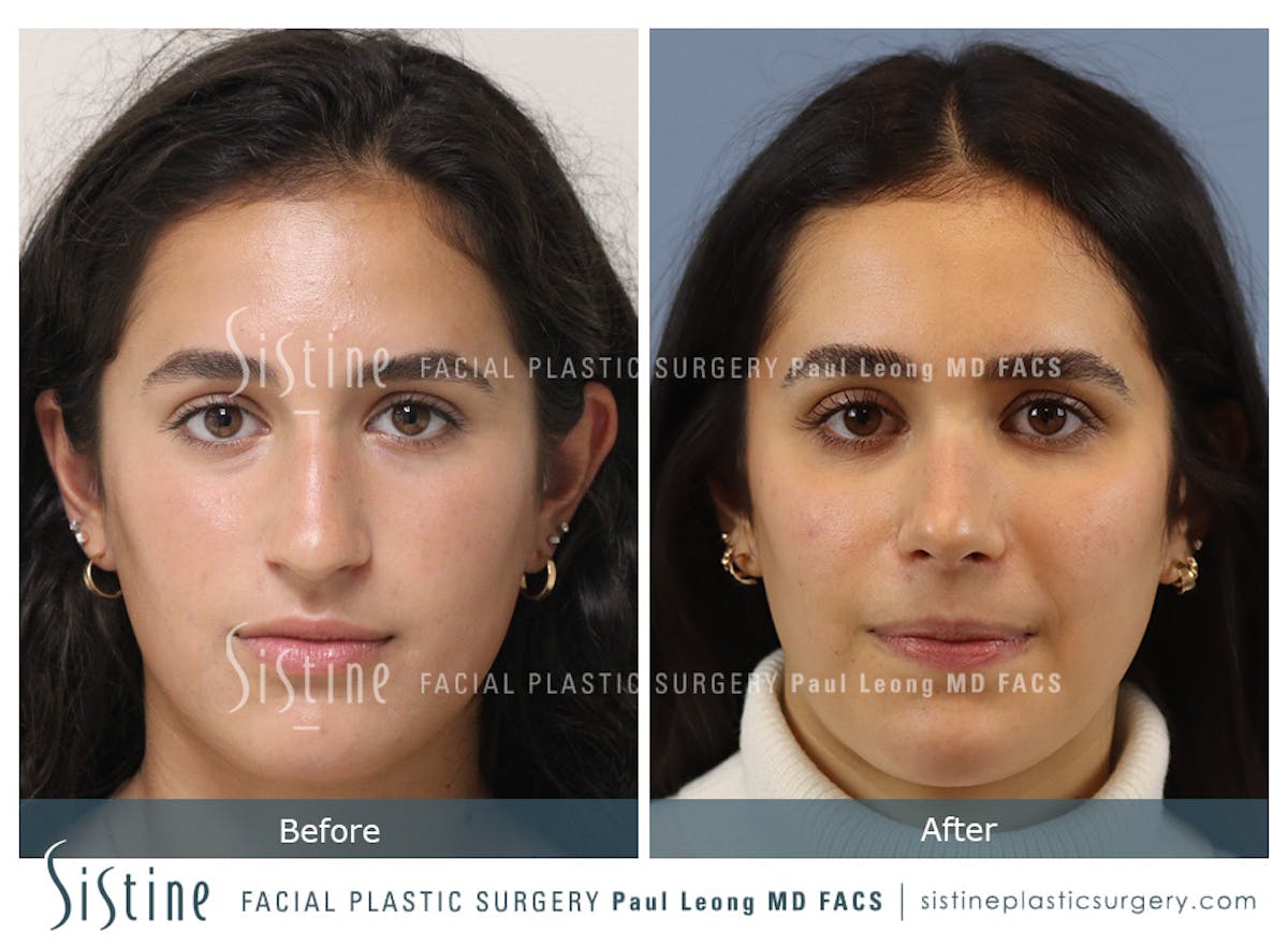 Rhinoplasty Before & After Gallery - Patient 293286 - Image 1