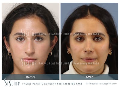Rhinoplasty Before & After Gallery - Patient 293286 - Image 1