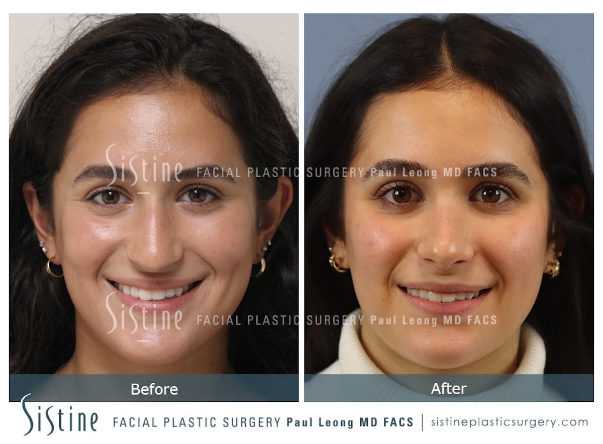 Rhinoplasty Before & After Gallery - Patient 293286 - Image 2