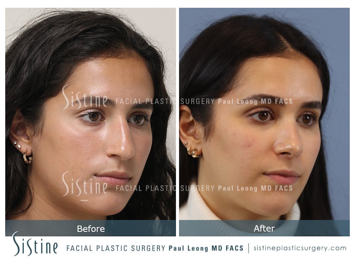 Rhinoplasty Before & After Gallery - Patient 293286 - Image 3