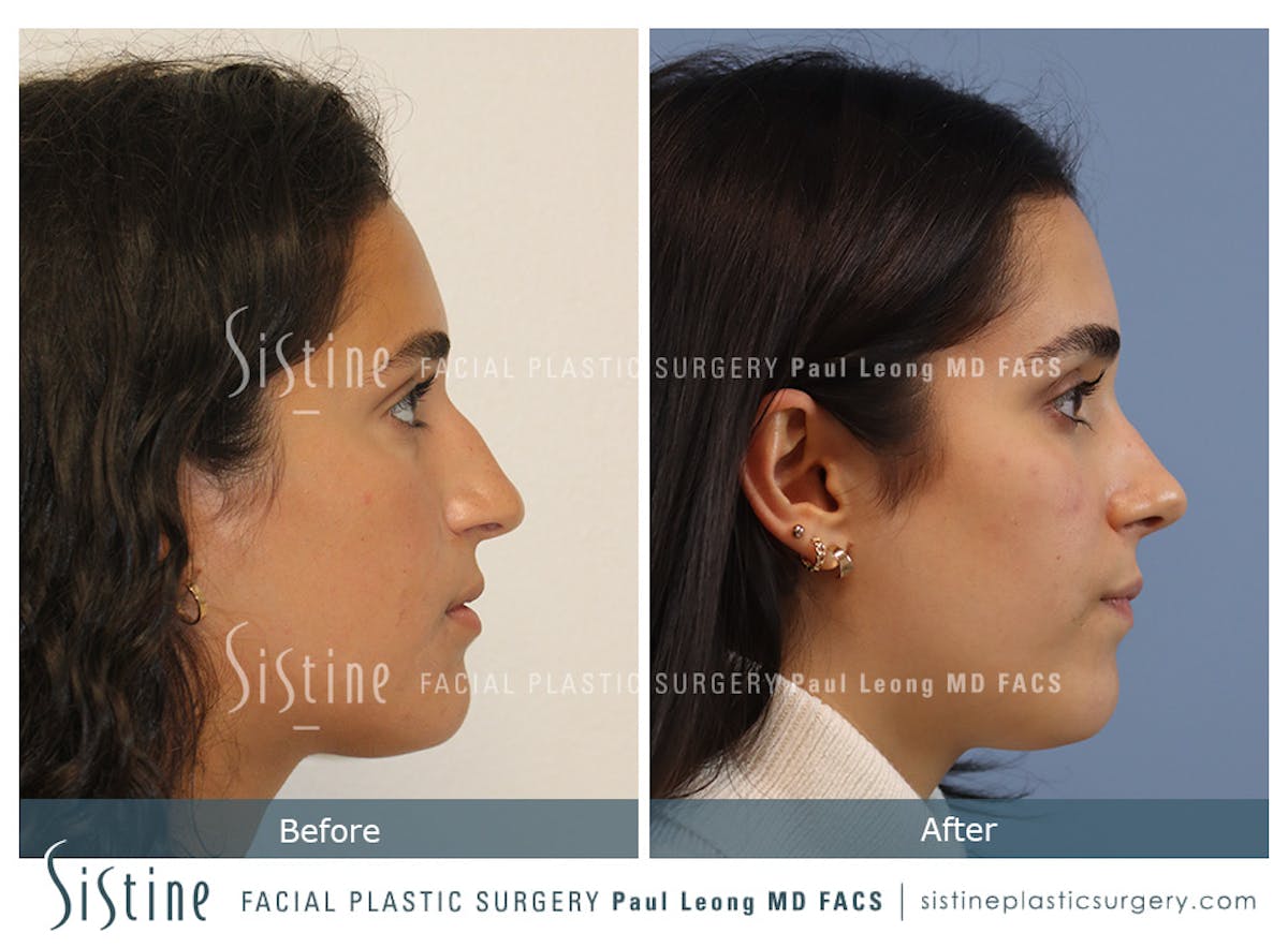 Rhinoplasty Before & After Gallery - Patient 293286 - Image 4