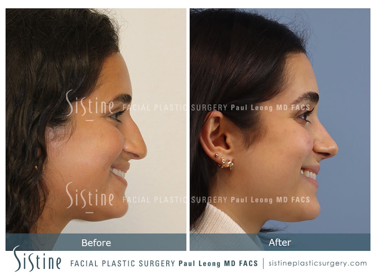 Rhinoplasty Before & After Gallery - Patient 293286 - Image 5