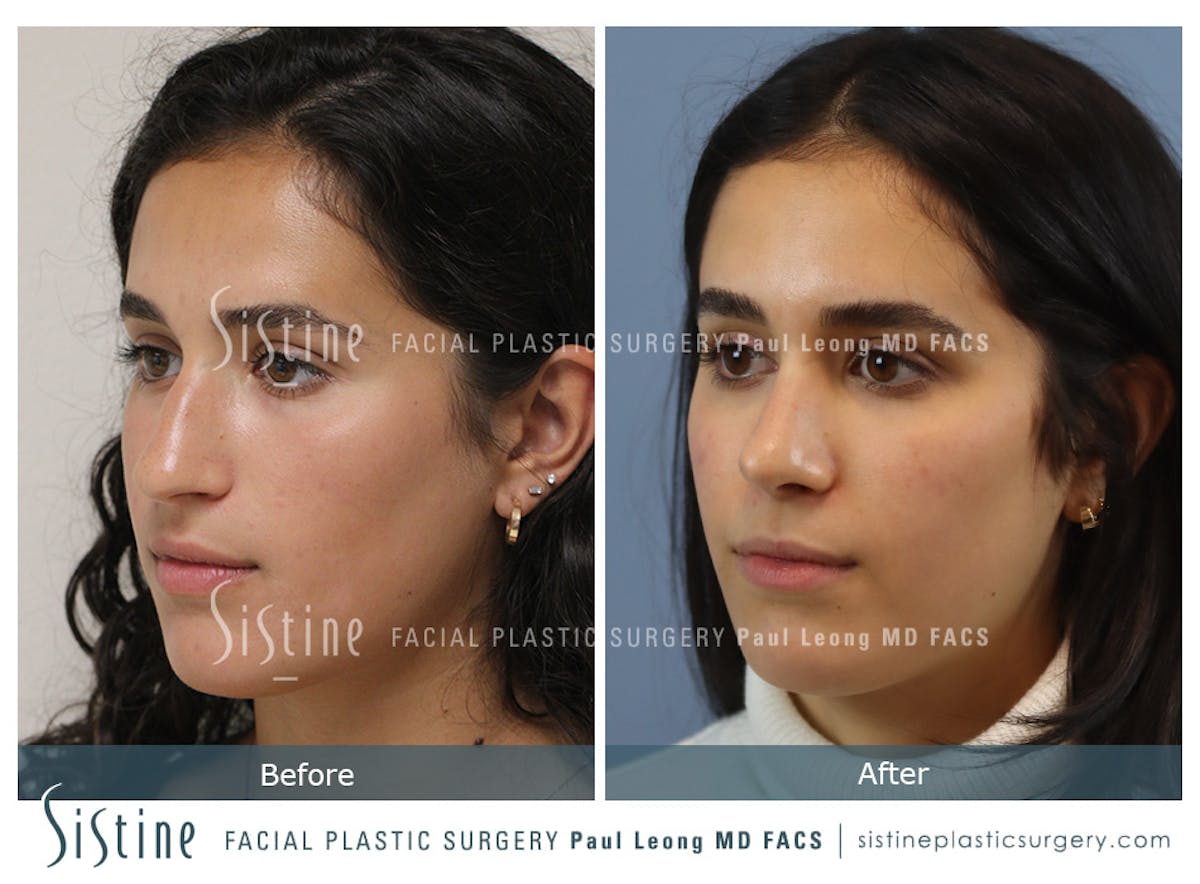 Rhinoplasty Before & After Gallery - Patient 293286 - Image 6
