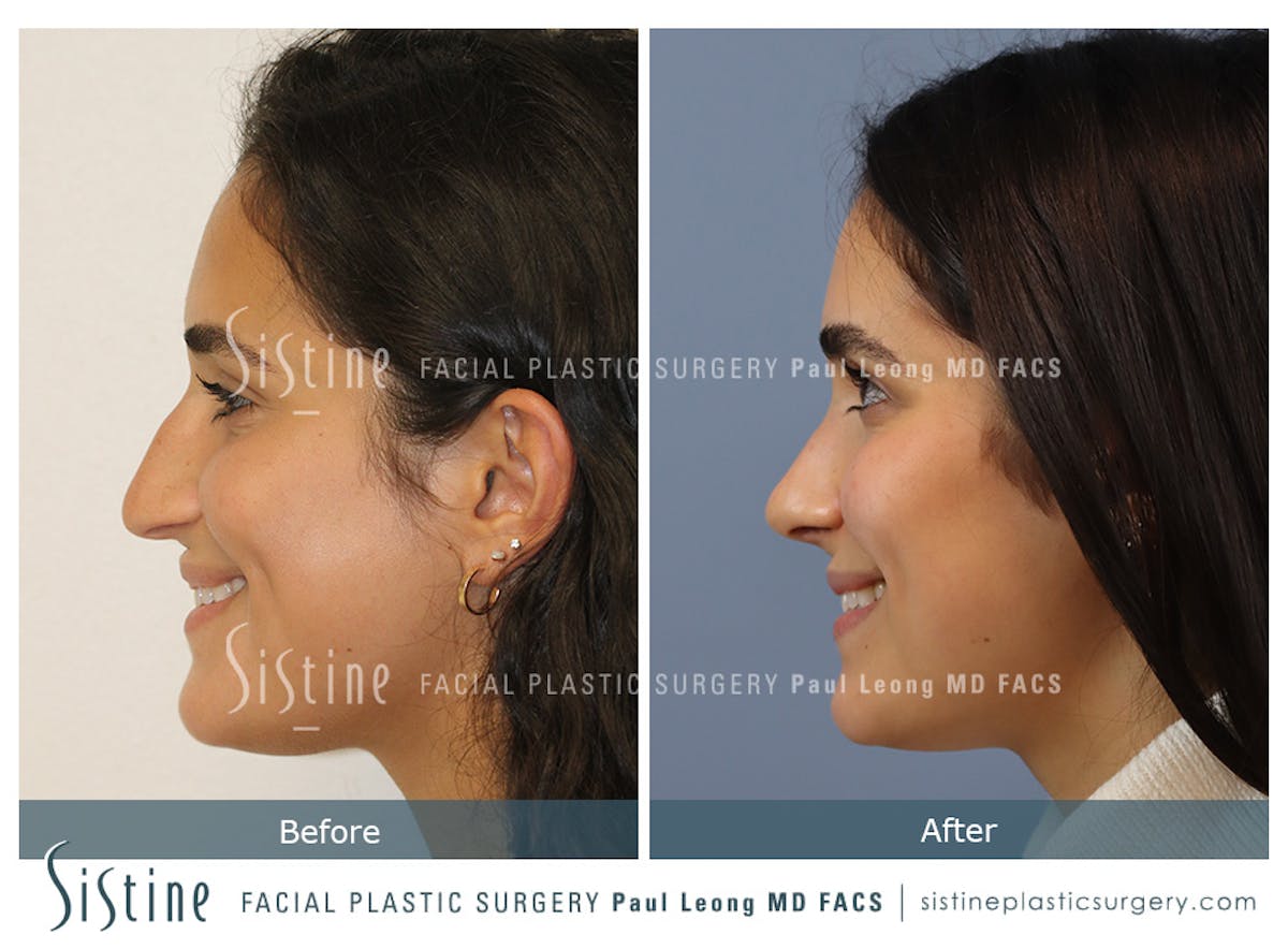 Rhinoplasty Before & After Gallery - Patient 293286 - Image 7