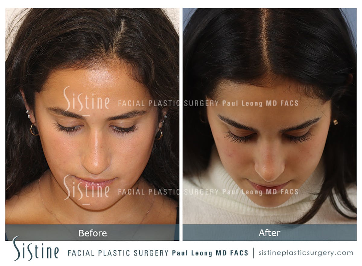 Rhinoplasty Before & After Gallery - Patient 293286 - Image 9