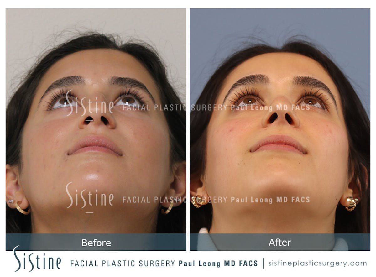 Rhinoplasty Before & After Gallery - Patient 293286 - Image 10