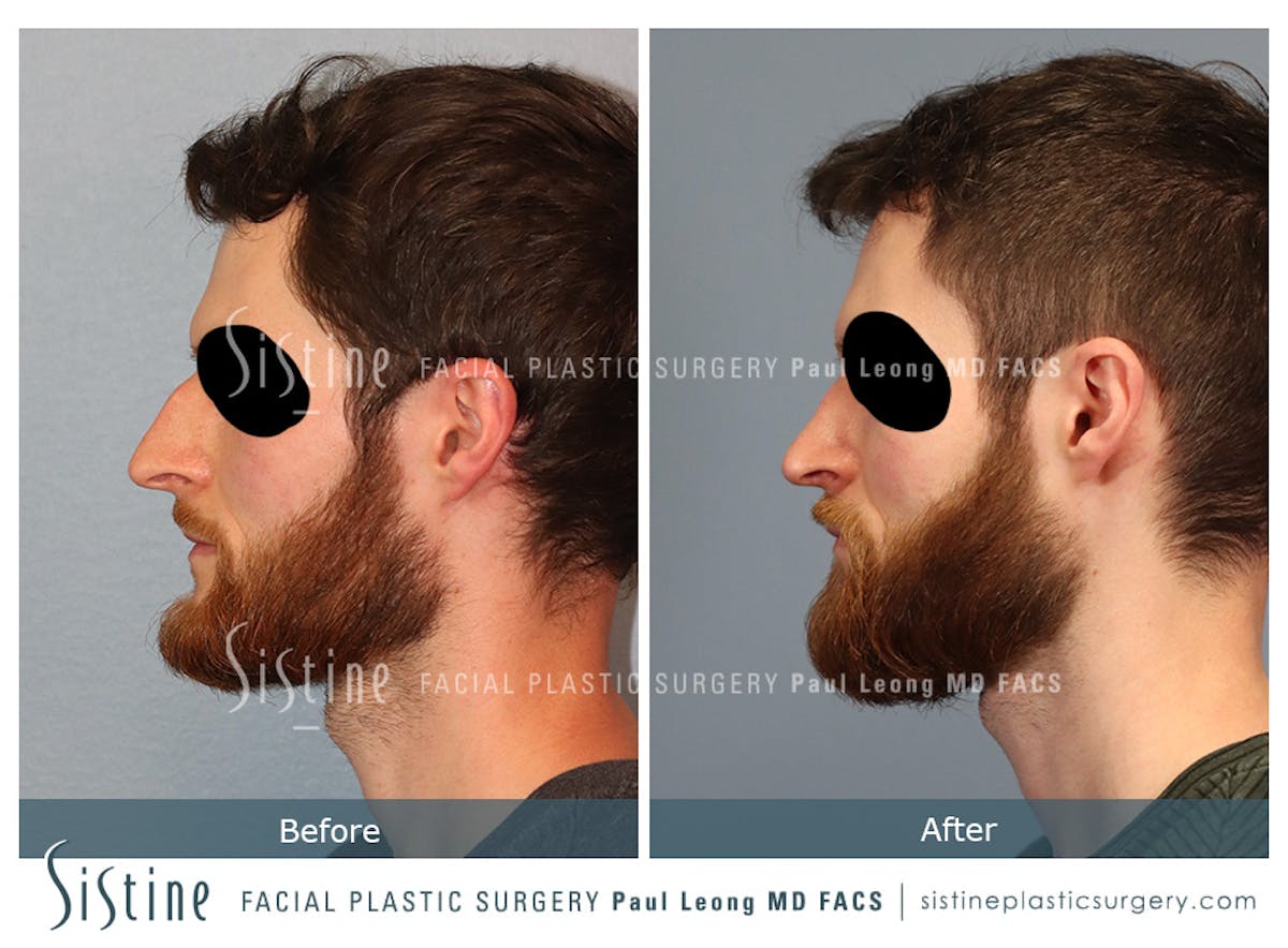 Rhinoplasty Before & After Gallery - Patient 274216 - Image 1