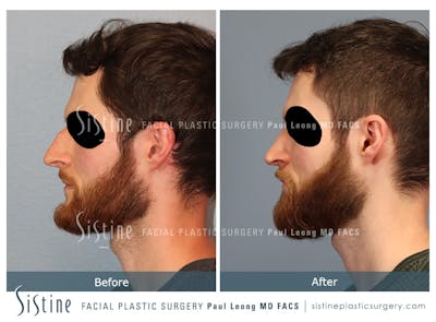 Rhinoplasty Before & After Gallery - Patient 274216 - Image 1