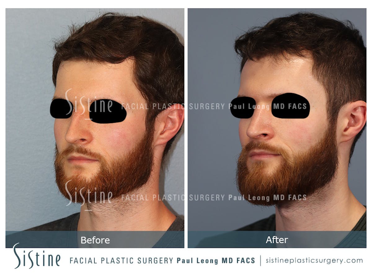 Rhinoplasty Before & After Gallery - Patient 274216 - Image 2