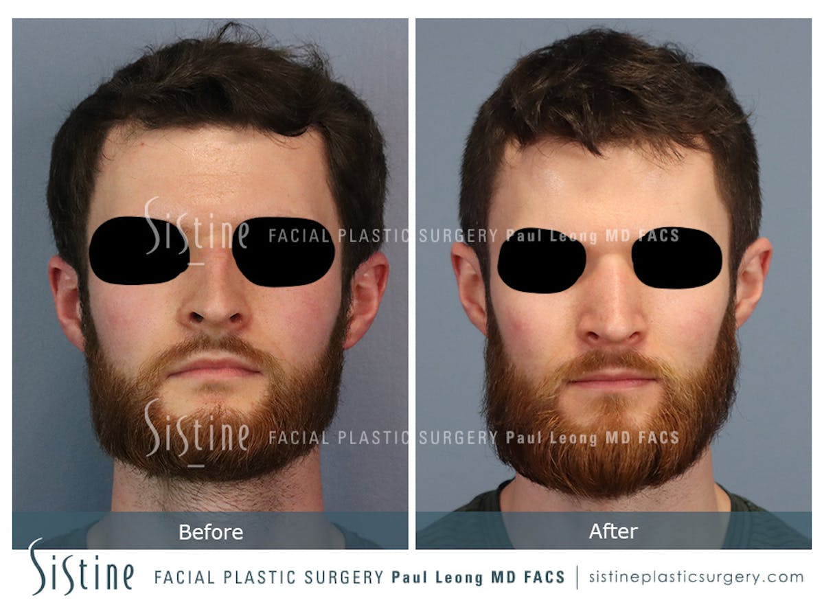 Rhinoplasty Before & After Gallery - Patient 274216 - Image 3