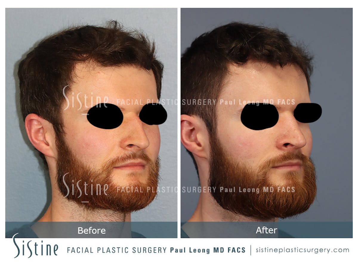 Rhinoplasty Before & After Gallery - Patient 274216 - Image 4