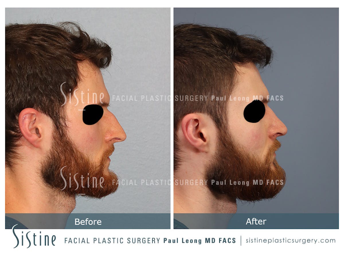 Rhinoplasty Before & After Gallery - Patient 274216 - Image 5