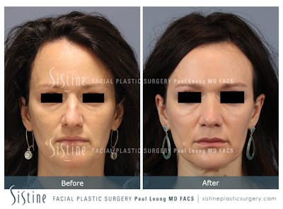 Rhinoplasty Before & After Gallery - Patient 267403 - Image 1