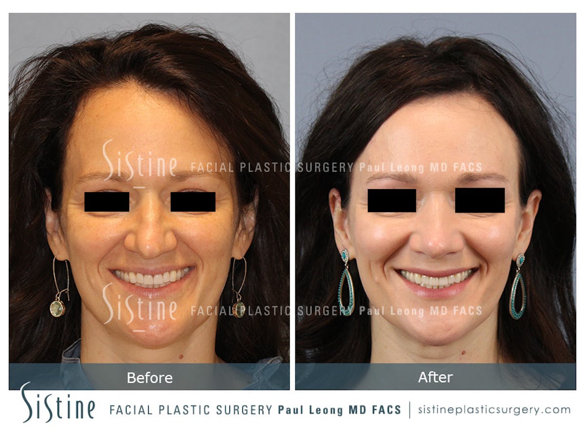 Rhinoplasty Before & After Gallery - Patient 267403 - Image 2