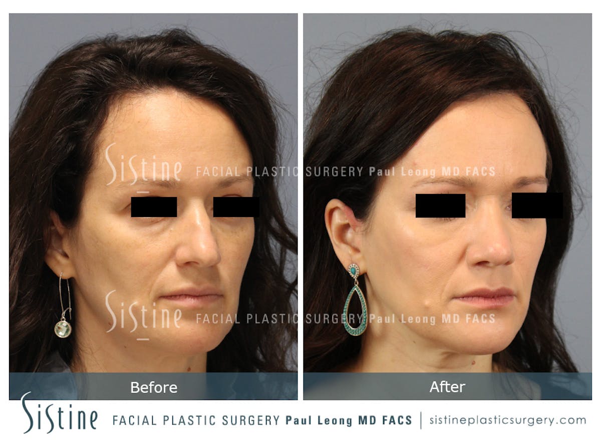 Rhinoplasty Before & After Gallery - Patient 267403 - Image 3