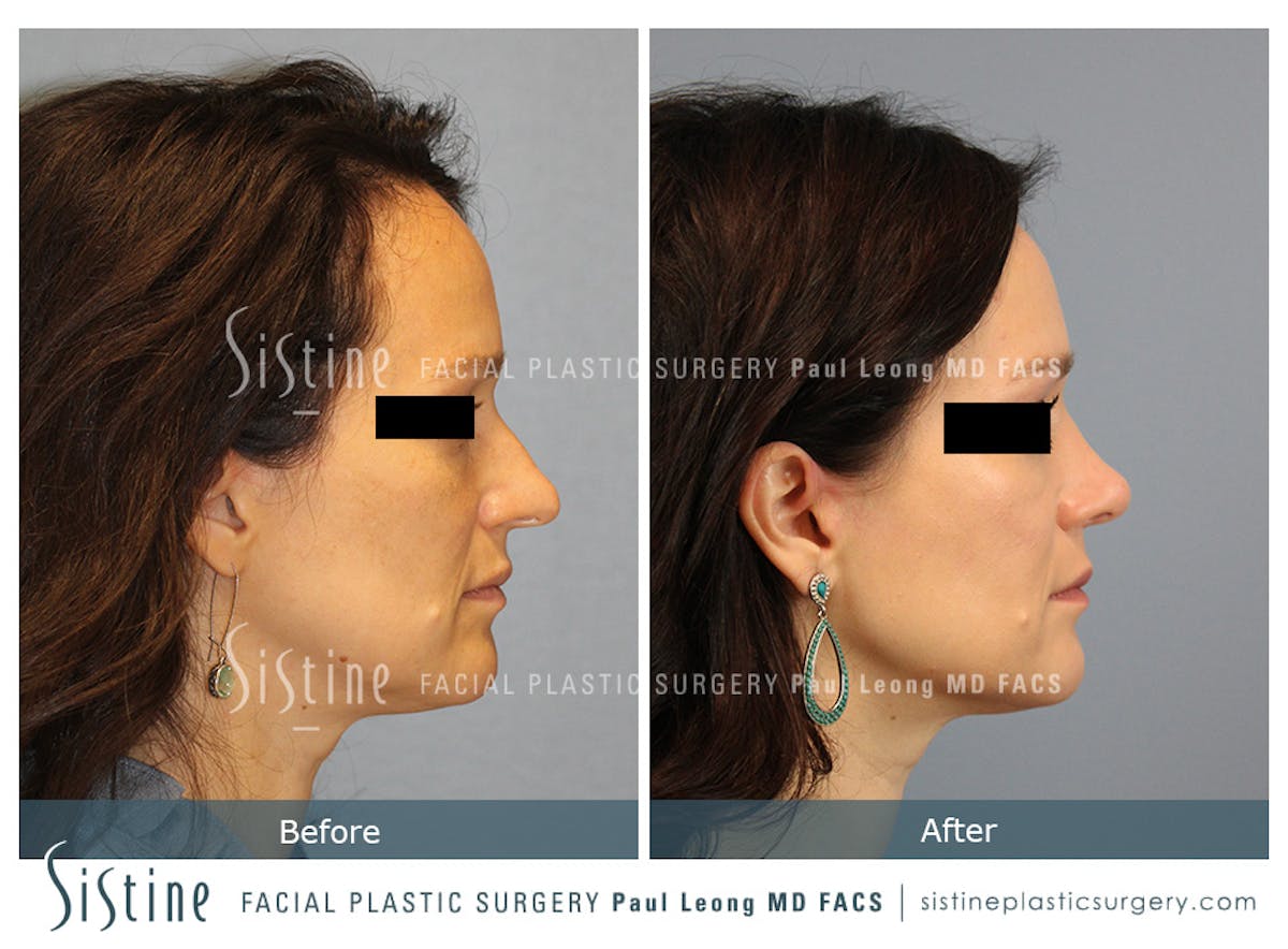 Rhinoplasty Before & After Gallery - Patient 267403 - Image 4