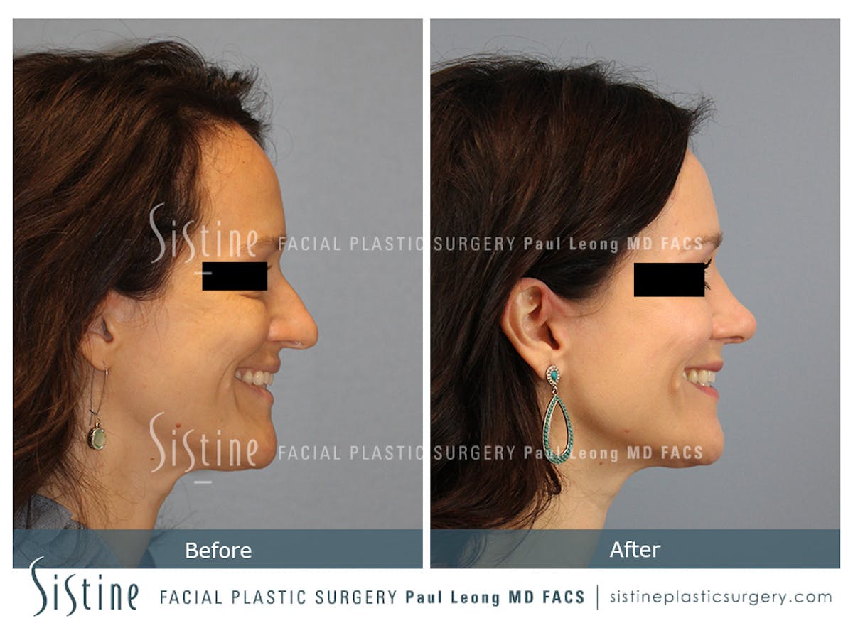 Rhinoplasty Before & After Gallery - Patient 267403 - Image 5