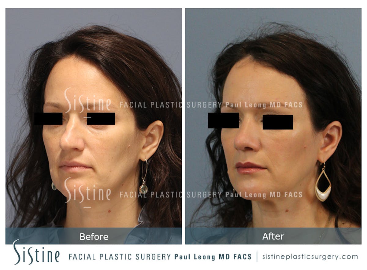 Rhinoplasty Before & After Gallery - Patient 267403 - Image 6