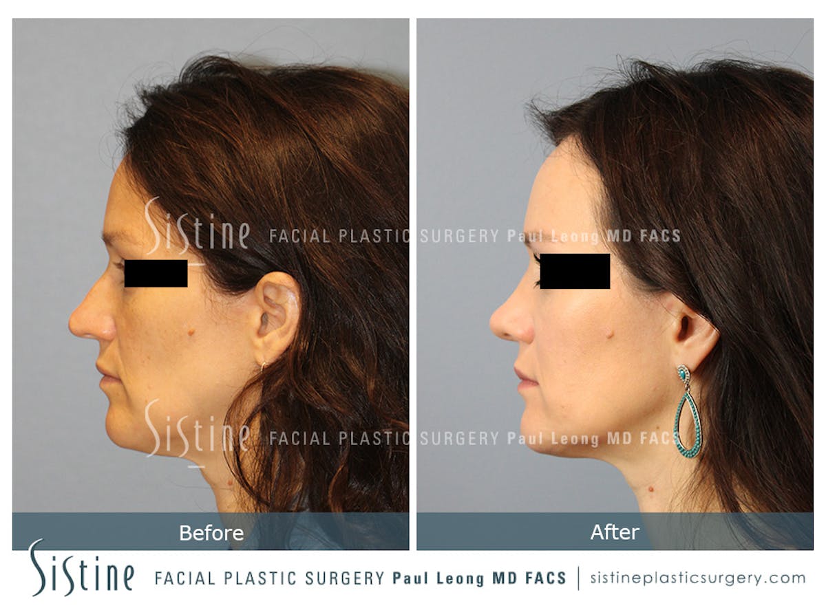 Rhinoplasty Before & After Gallery - Patient 267403 - Image 7