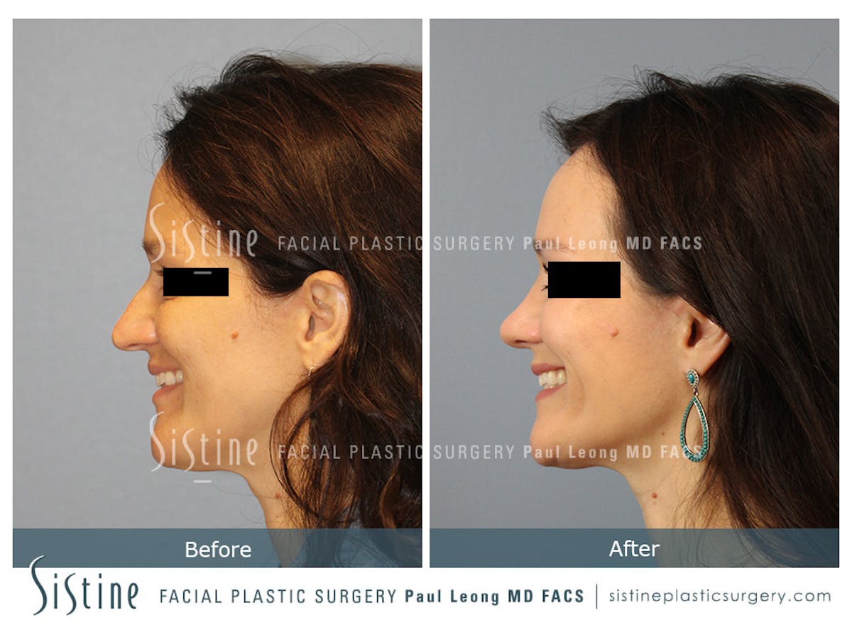 Rhinoplasty Before & After Gallery - Patient 267403 - Image 8