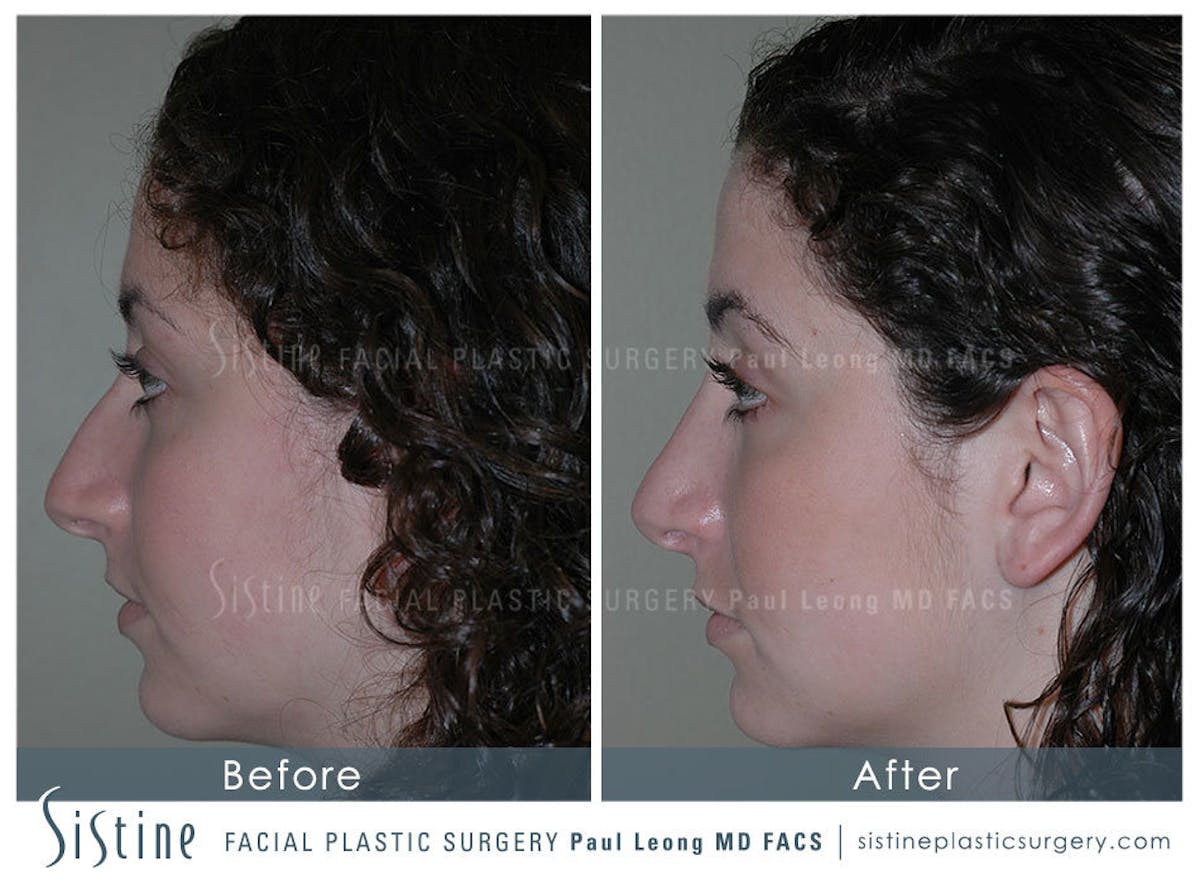 Rhinoplasty Before & After Gallery - Patient 336108 - Image 4
