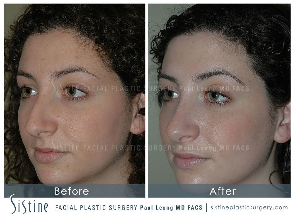 Rhinoplasty Before & After Gallery - Patient 336108 - Image 5