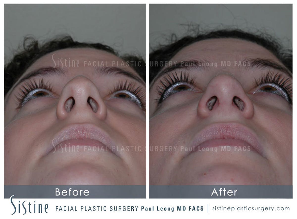 Rhinoplasty Before & After Gallery - Patient 336108 - Image 6