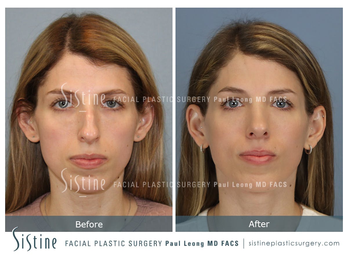 Rhinoplasty Before & After Gallery - Patient 419555 - Image 1