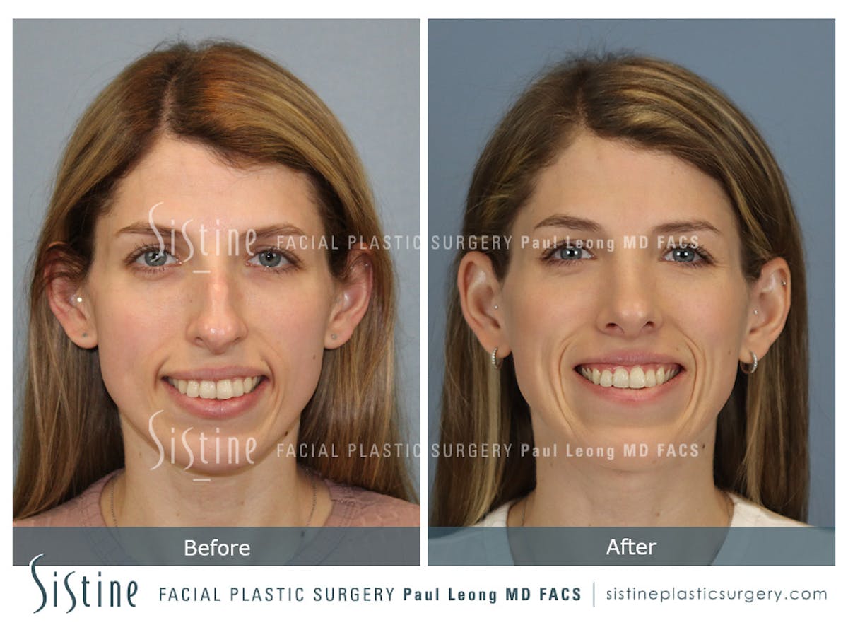 Rhinoplasty Before & After Gallery - Patient 419555 - Image 2