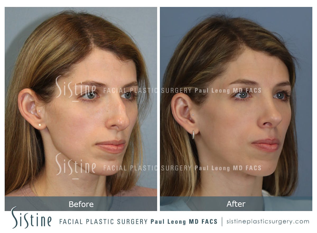 Rhinoplasty Before & After Gallery - Patient 419555 - Image 3