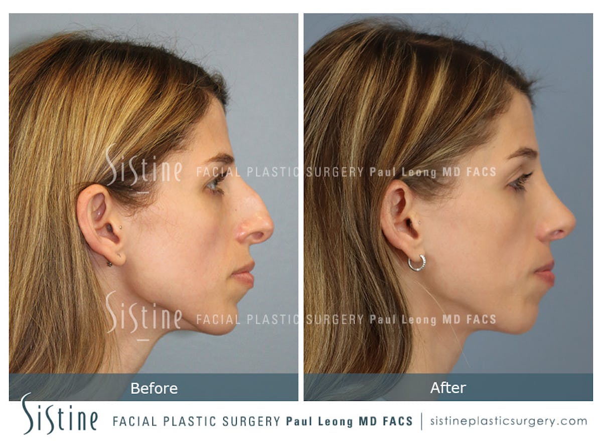 Rhinoplasty Before & After Gallery - Patient 419555 - Image 4