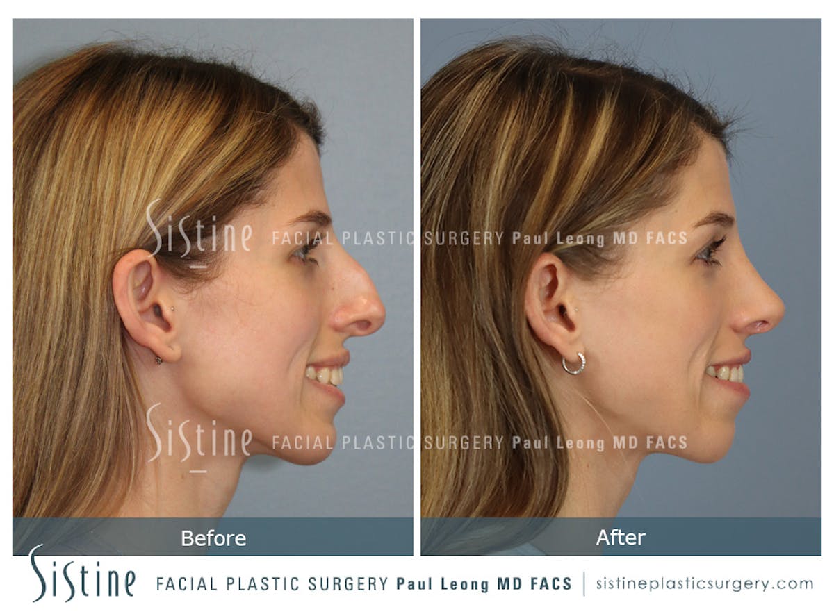 Rhinoplasty Before & After Gallery - Patient 419555 - Image 5
