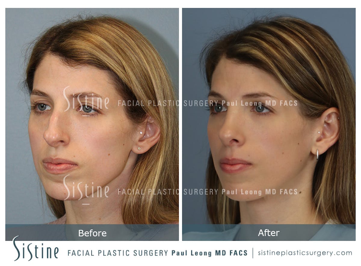 Rhinoplasty Before & After Gallery - Patient 419555 - Image 6