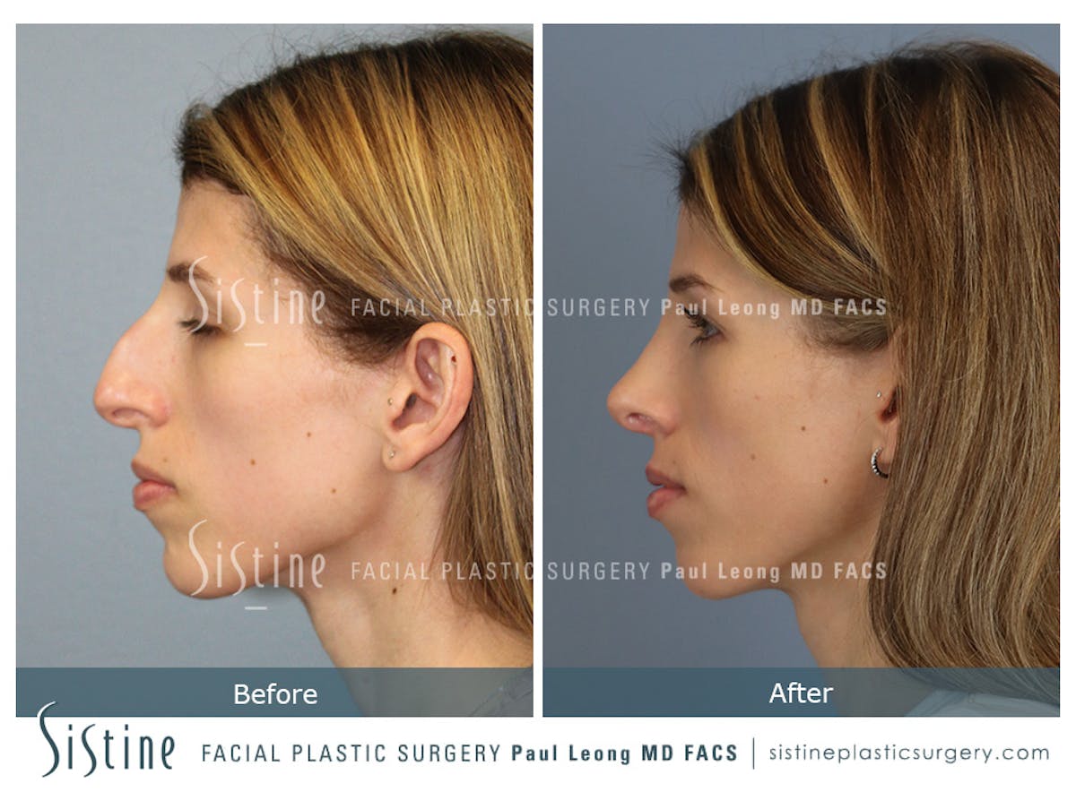 Rhinoplasty Before & After Gallery - Patient 419555 - Image 7