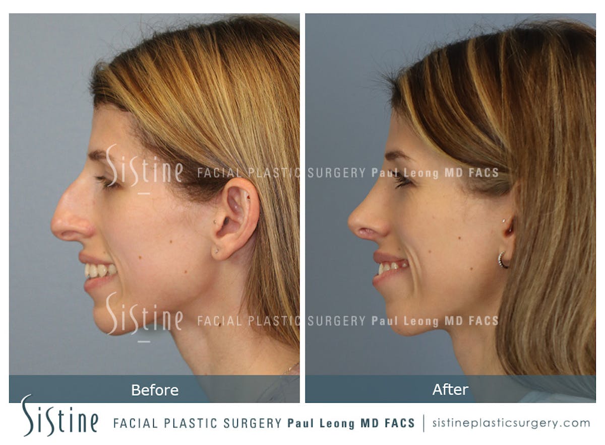 Rhinoplasty Before & After Gallery - Patient 419555 - Image 8
