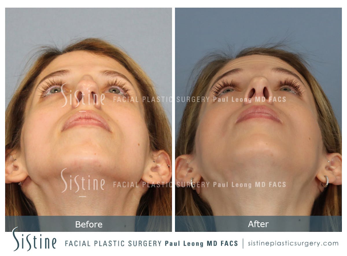 Rhinoplasty Before & After Gallery - Patient 419555 - Image 9