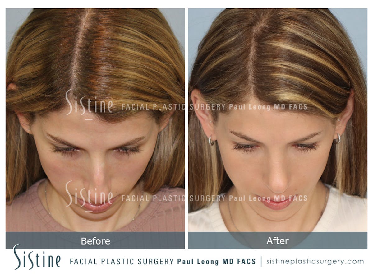 Rhinoplasty Before & After Gallery - Patient 419555 - Image 10