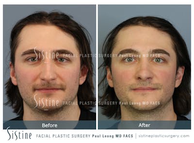 Rhinoplasty Before & After Gallery - Patient 827783 - Image 1