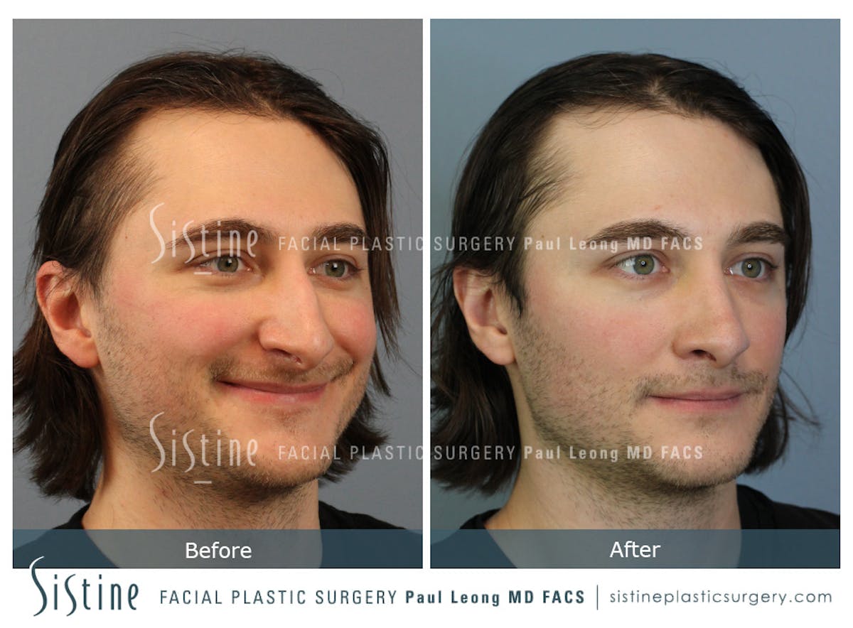 Rhinoplasty Before & After Gallery - Patient 827783 - Image 2