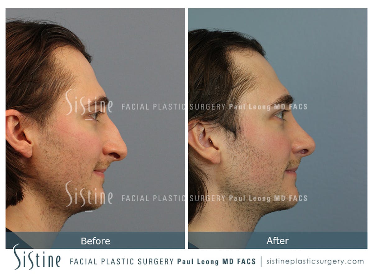 Rhinoplasty Before & After Gallery - Patient 827783 - Image 3