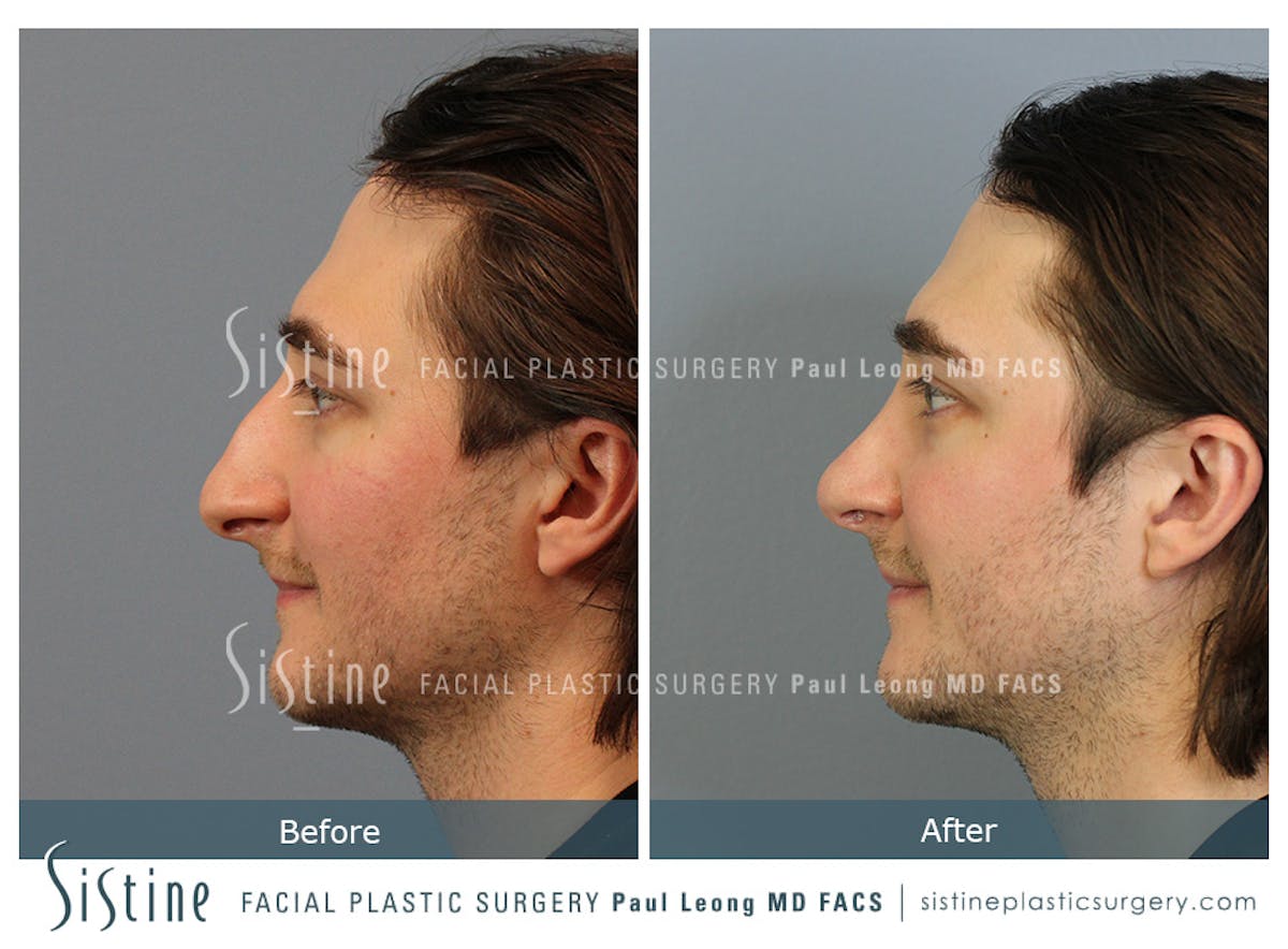 Rhinoplasty Before & After Gallery - Patient 827783 - Image 4