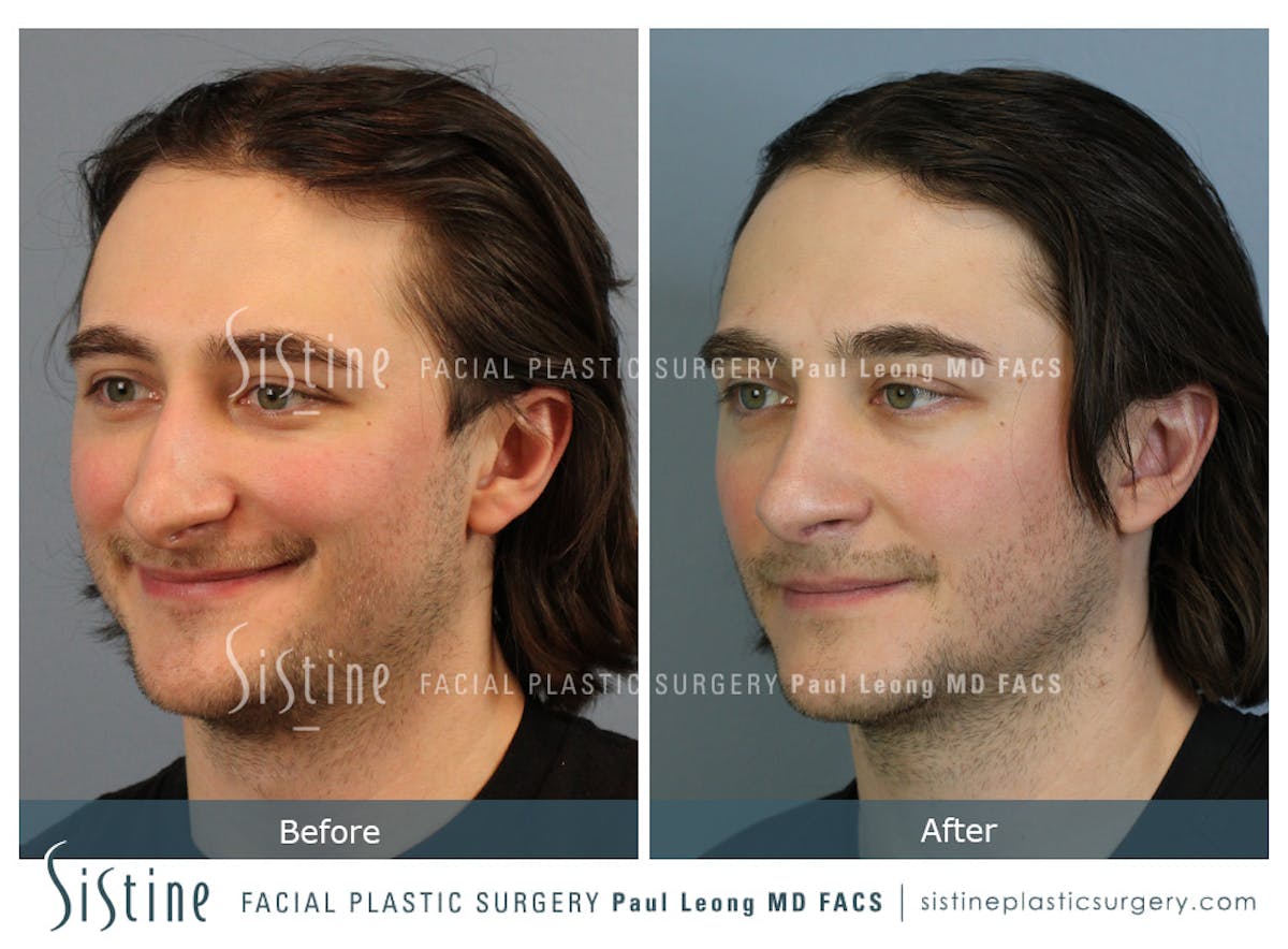 Rhinoplasty Before & After Gallery - Patient 827783 - Image 5