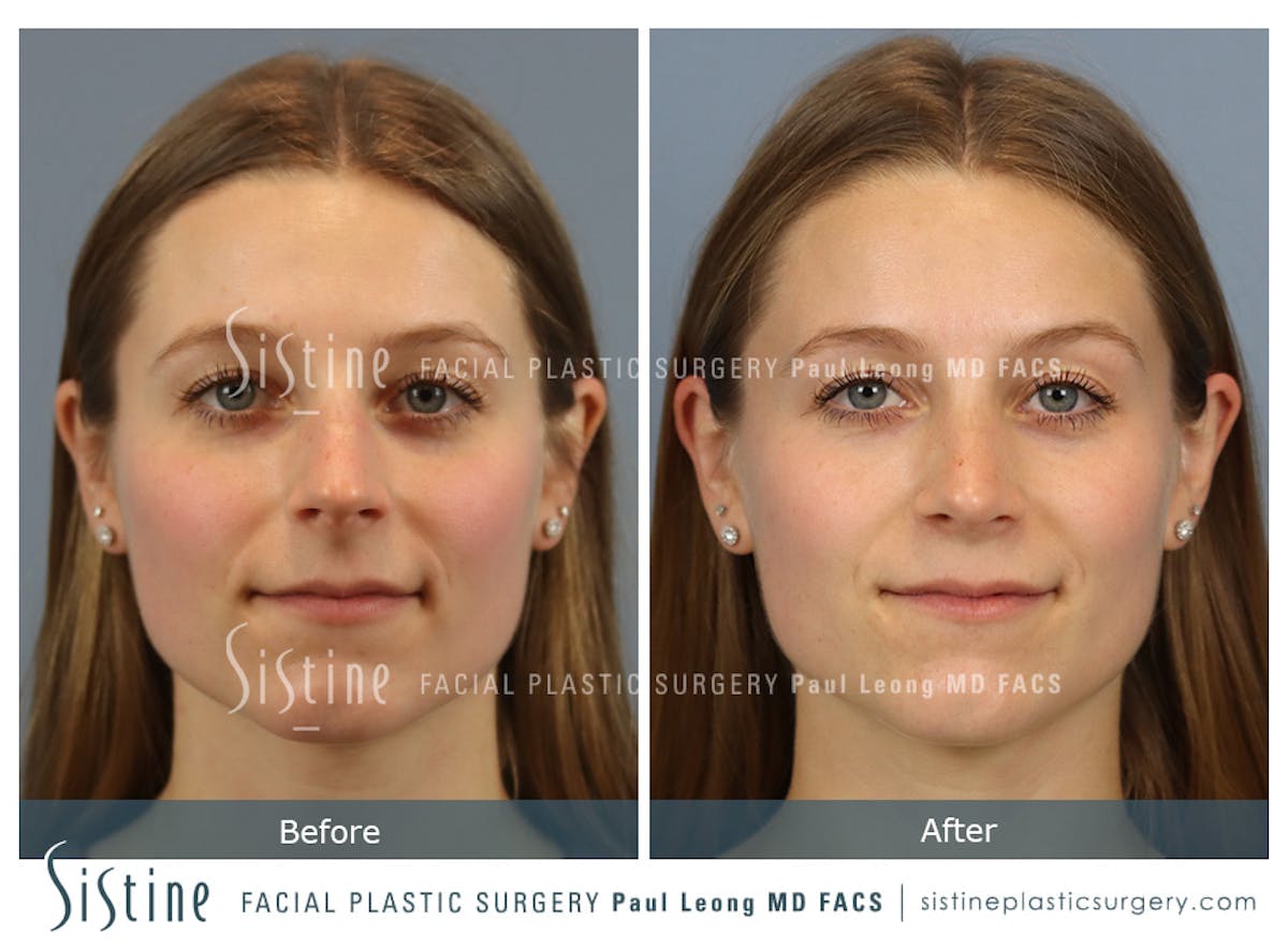 Rhinoplasty Before & After Gallery - Patient 152681 - Image 1