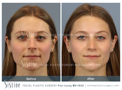 Rhinoplasty Before & After Gallery - Patient 152681 - Image 1