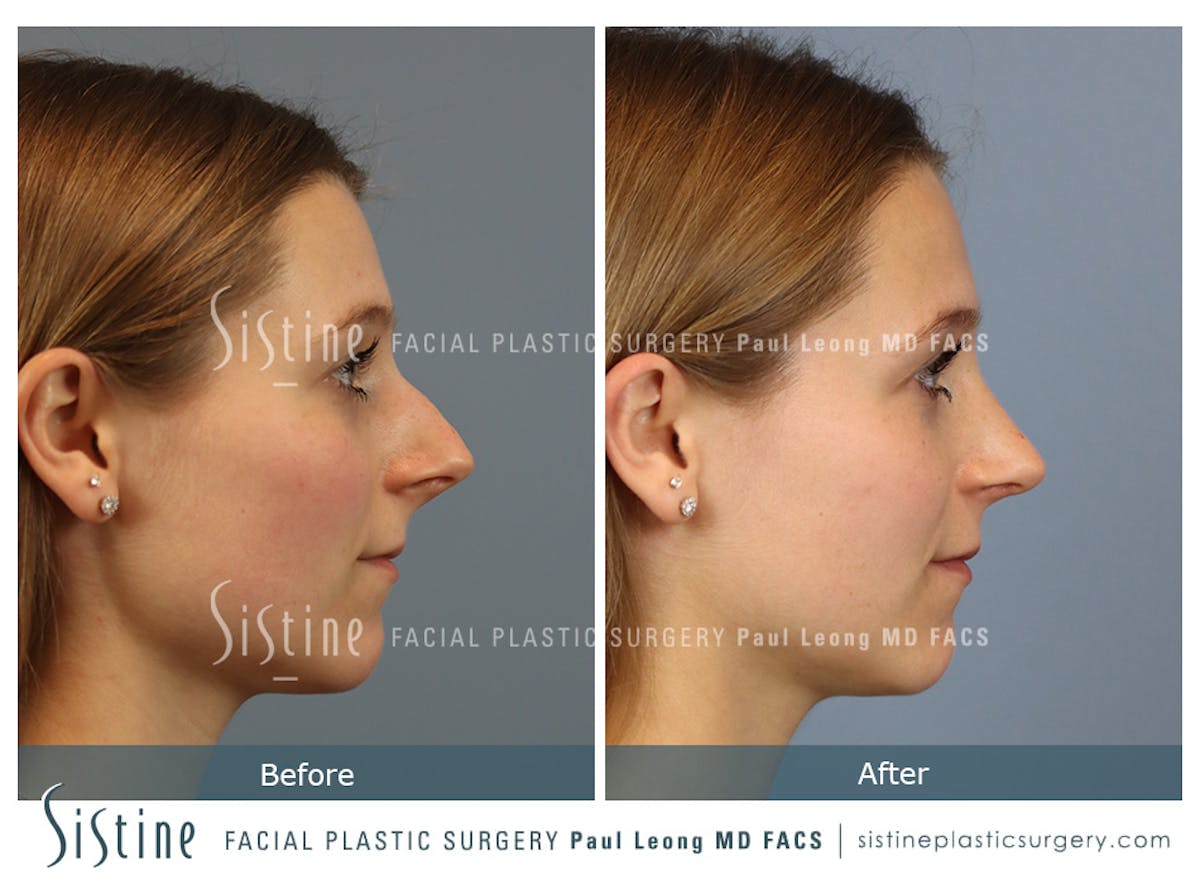 Rhinoplasty Before & After Gallery - Patient 152681 - Image 3
