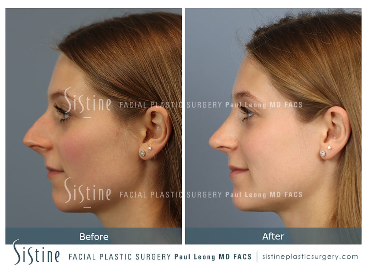 Rhinoplasty Before & After Gallery - Patient 152681 - Image 4