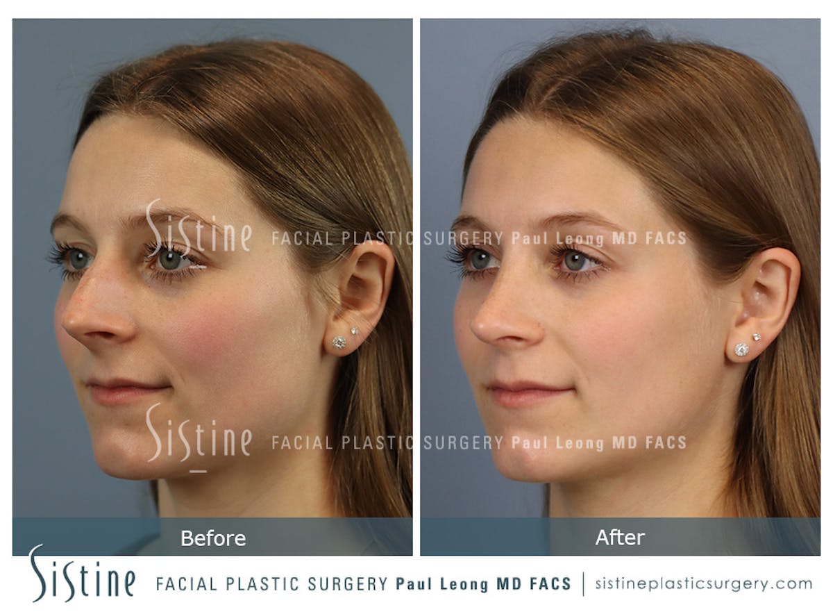 Rhinoplasty Before & After Gallery - Patient 152681 - Image 5