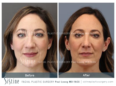 Rhinoplasty Before & After Gallery - Patient 245343 - Image 1
