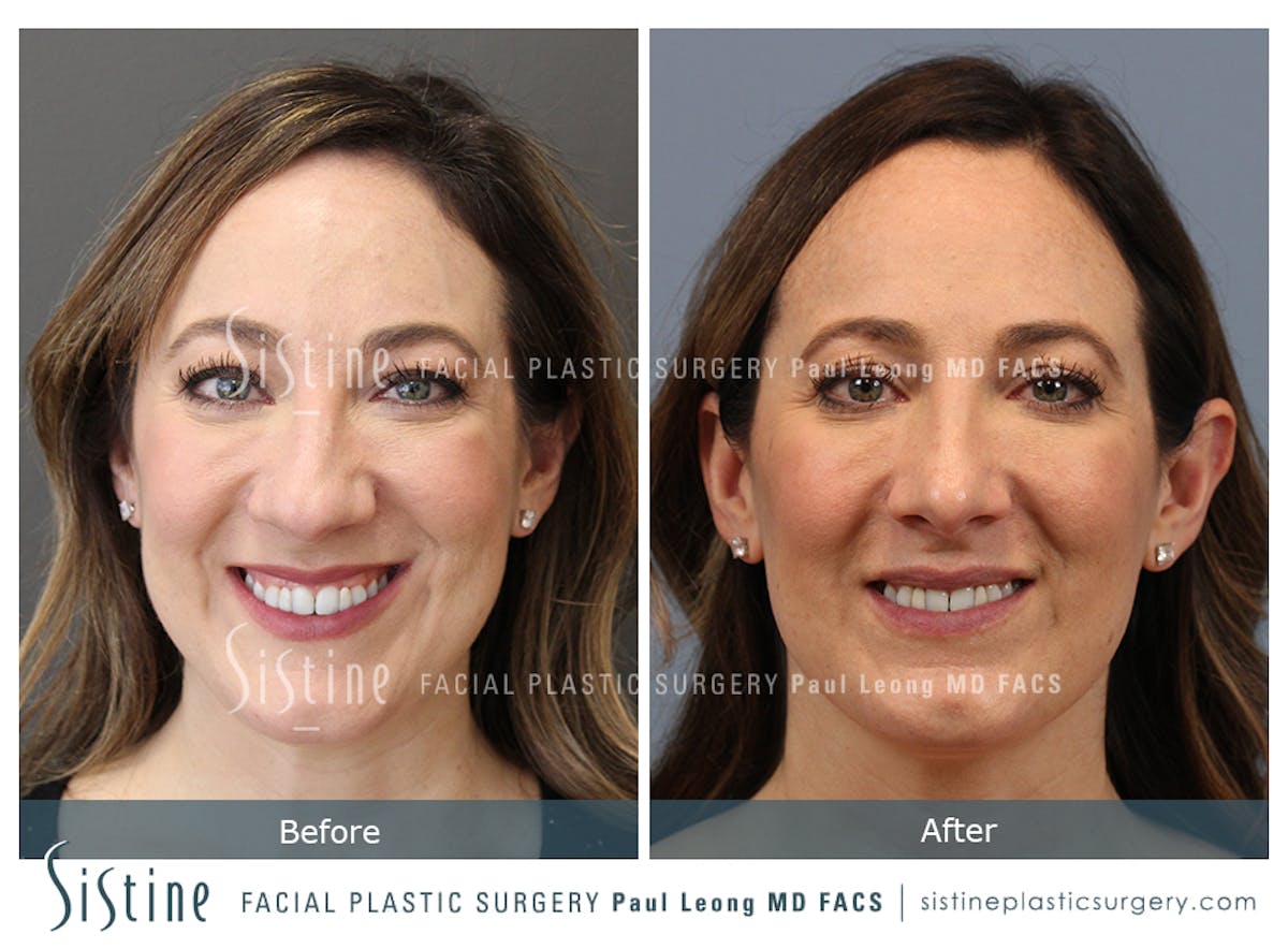 Rhinoplasty Before & After Gallery - Patient 245343 - Image 2